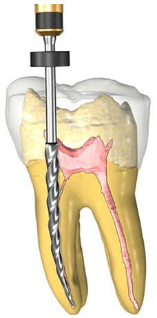 Root Canal Treatment Portland OR - Endodontics
