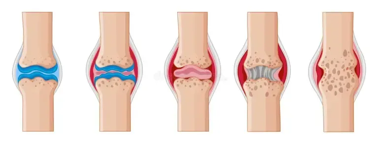 Illustration of a joint with stages of arthritis.  The joint shows changes, including swelling and bone damage.