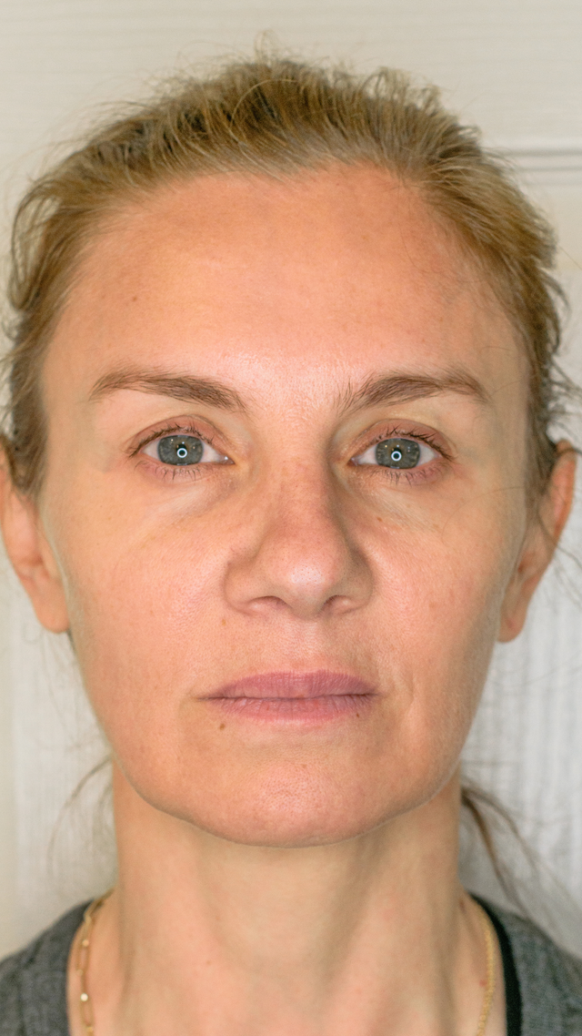 MIcro Lift Threads : Latest Revelation in Face and Body Lift http