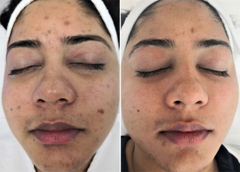 AquafirmeXS Hydrofacial Machine before and after results with improved skin.