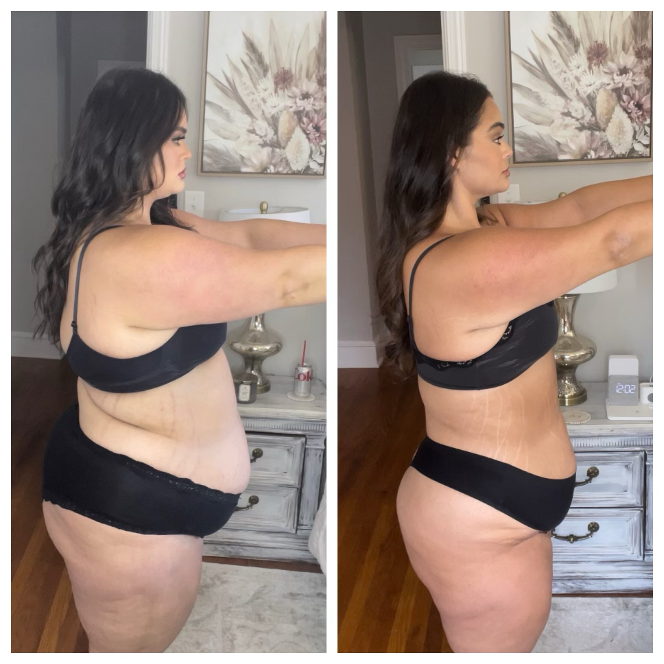 A client who lost 85 pounds on semiglutide injections over 11 months. 