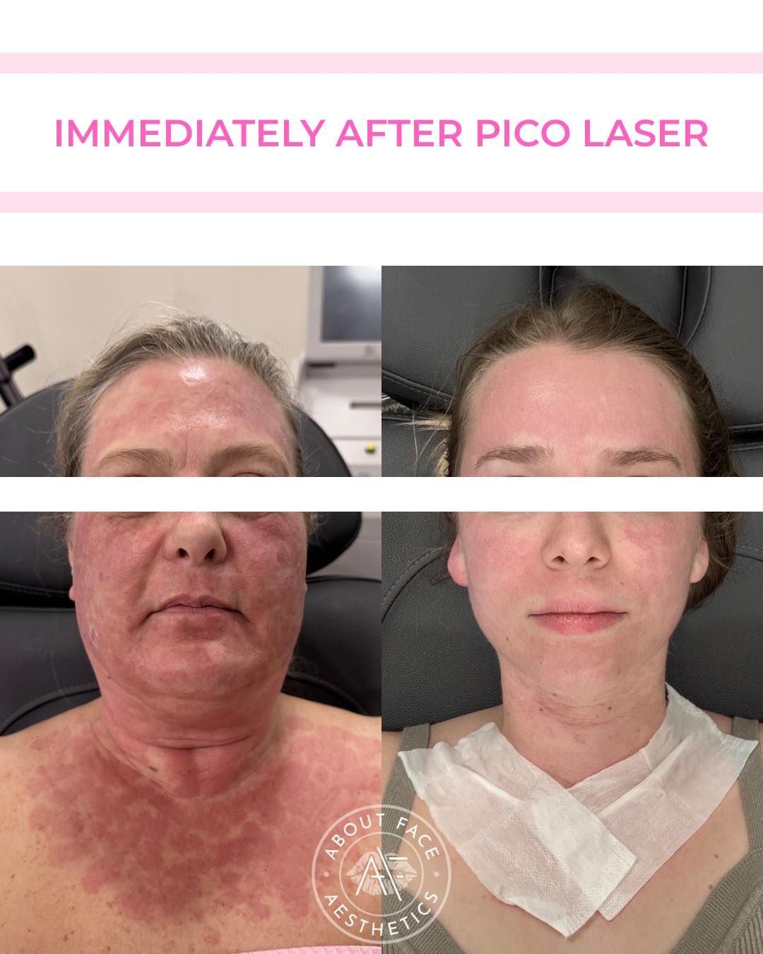 pico-laser-union-sc