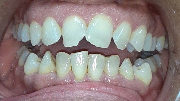 A close up of a man 's teeth with a beard.