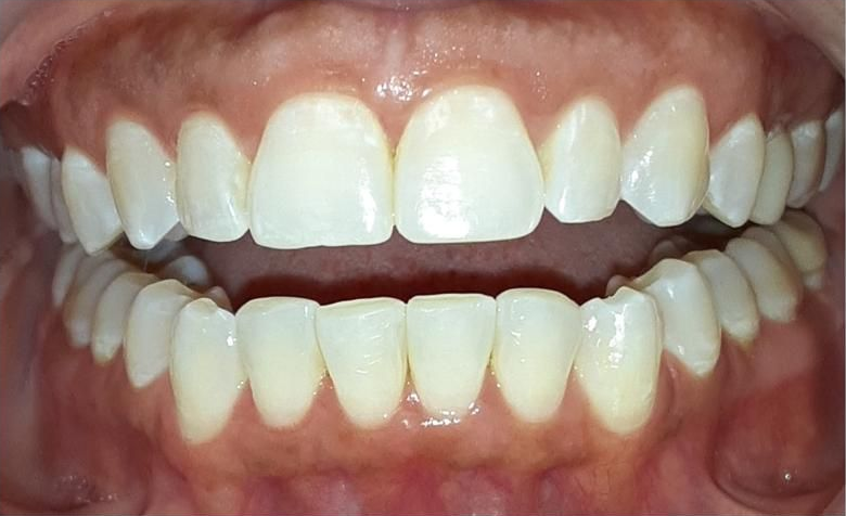 A close up of a person 's teeth in a mouth guard.