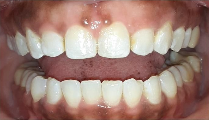 A close up of a person 's teeth in a mouth guard.