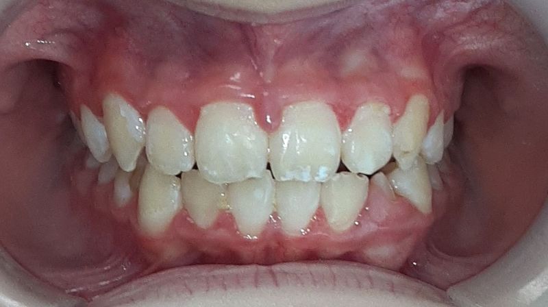 A close up of a person 's teeth in a mouth guard.