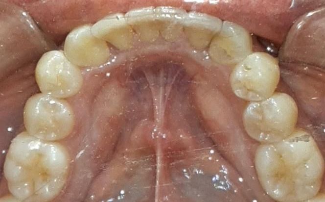 A close up of a person 's teeth and mouth.