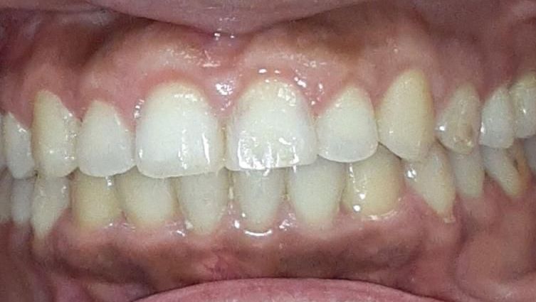 After Invisalign