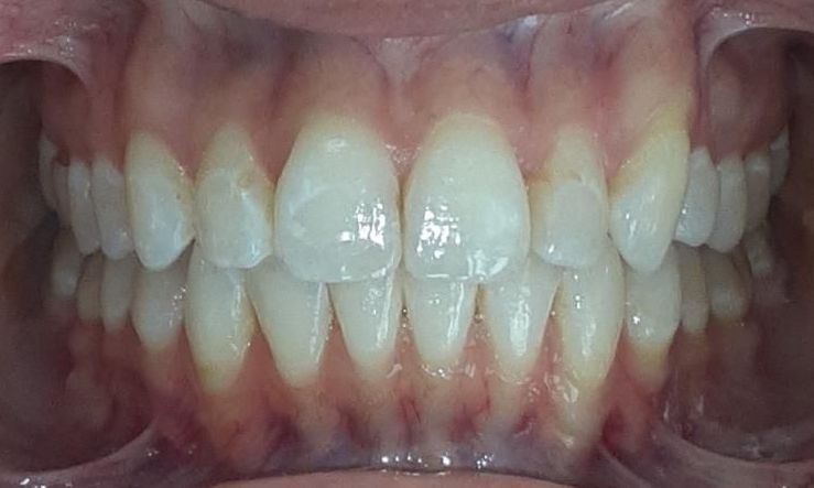 A close up of a person 's teeth with white teeth.