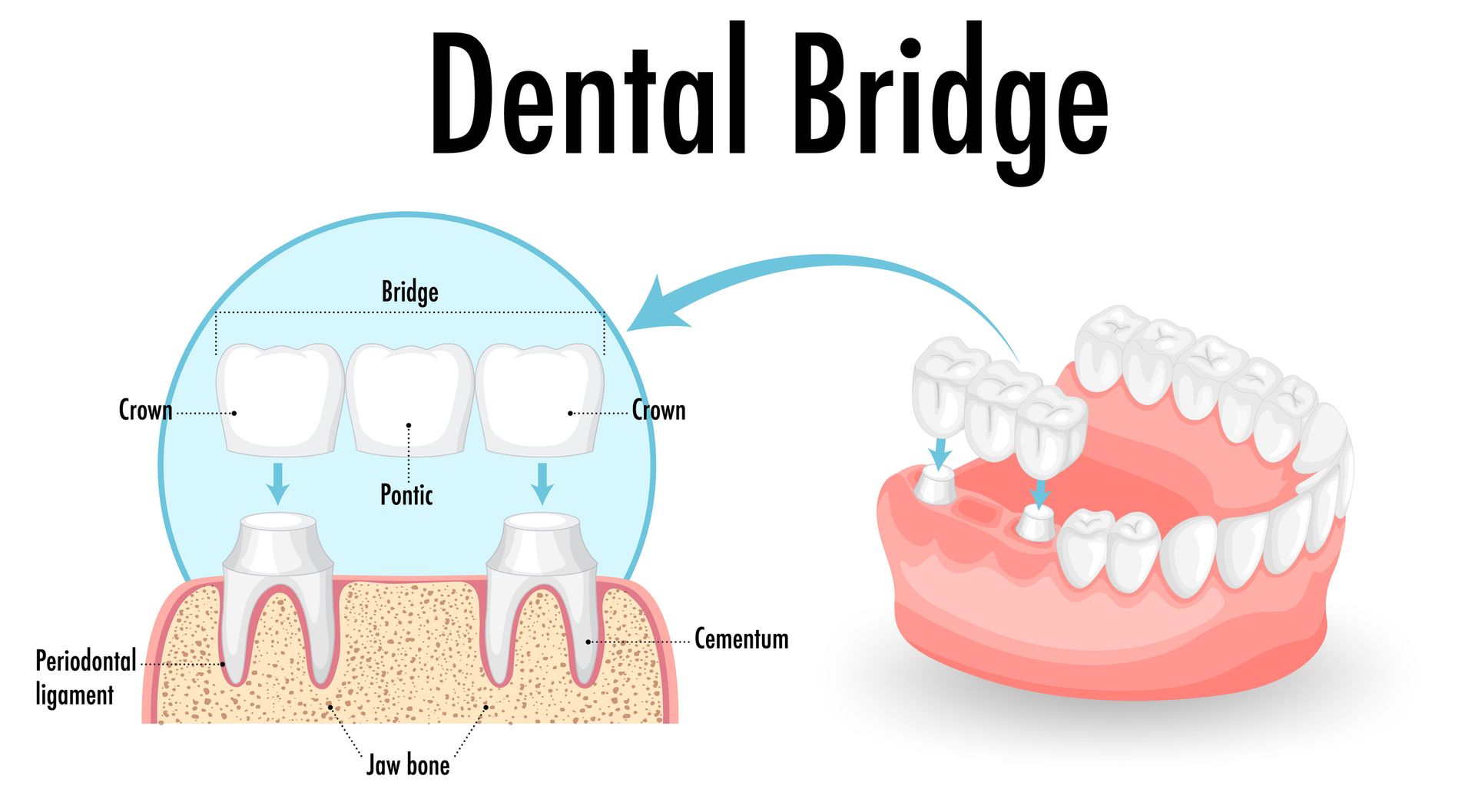 Dental bridge example