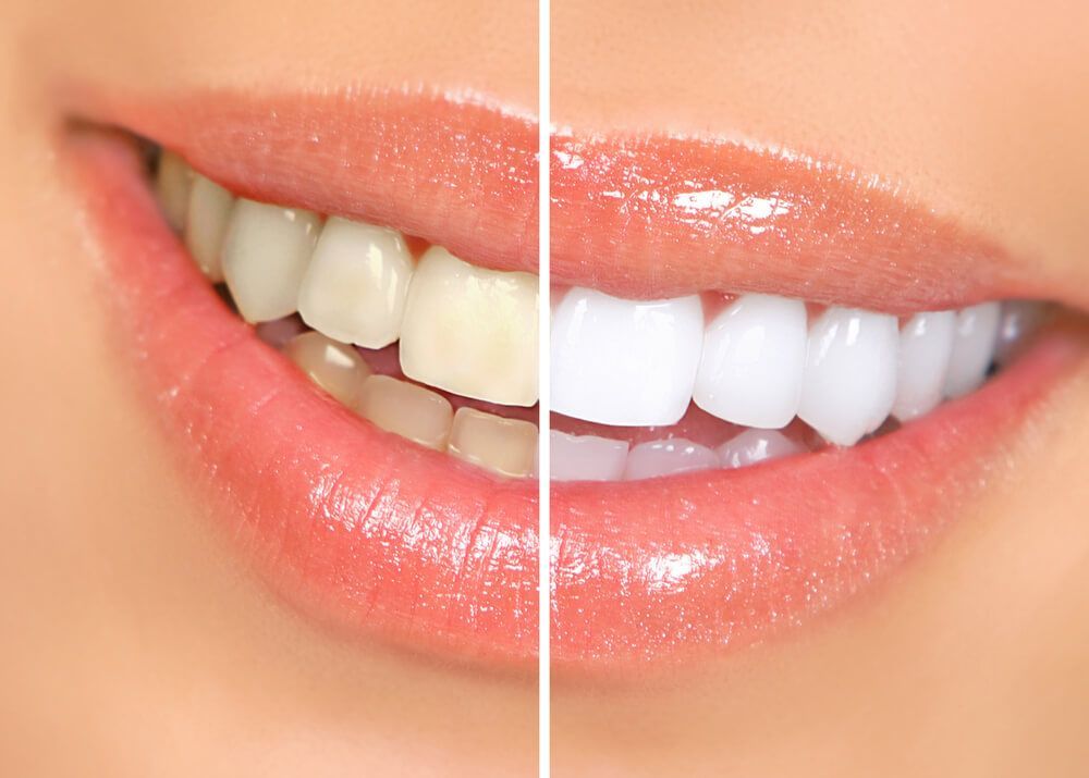 A before and after picture of a woman 's teeth.