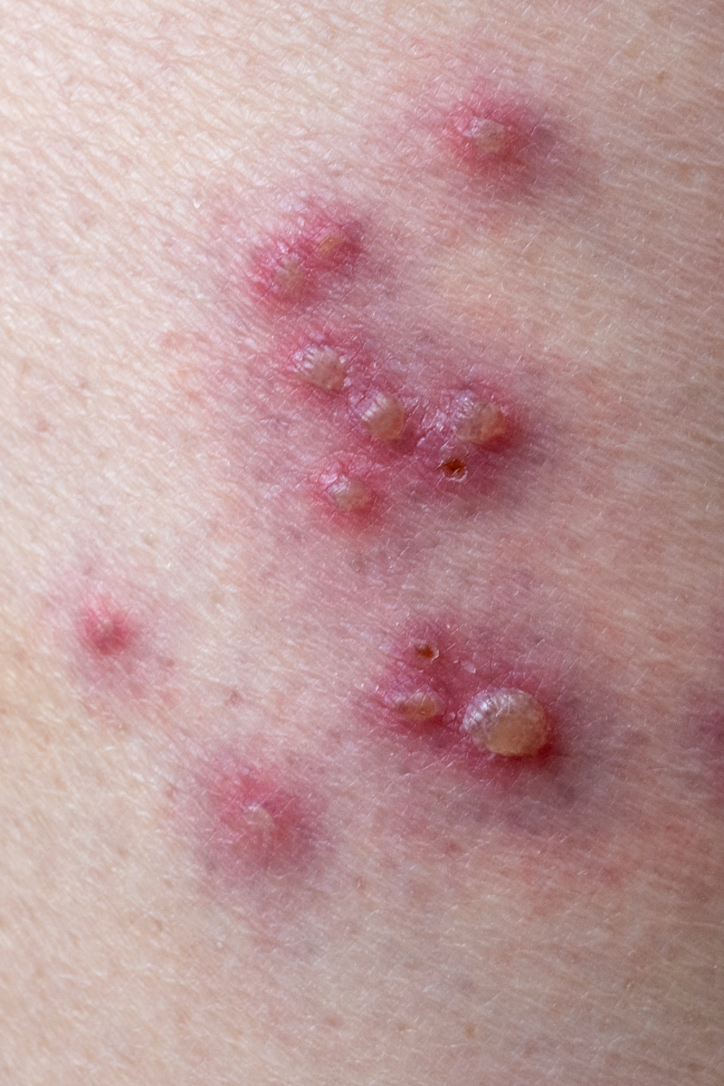 Herpes genital de repetição e imunidade baixa - 11 verdades importantes que você precisa saber