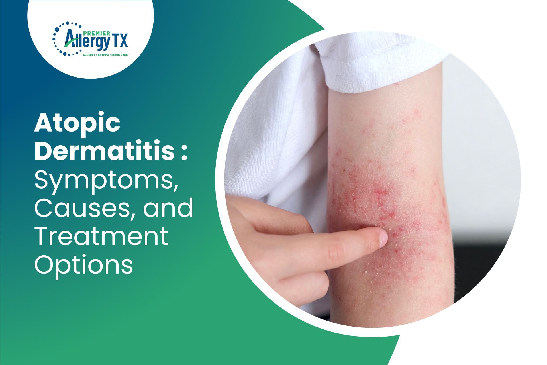 Symptoms, Causes, and Treatment Options for Atopic Dermatitis