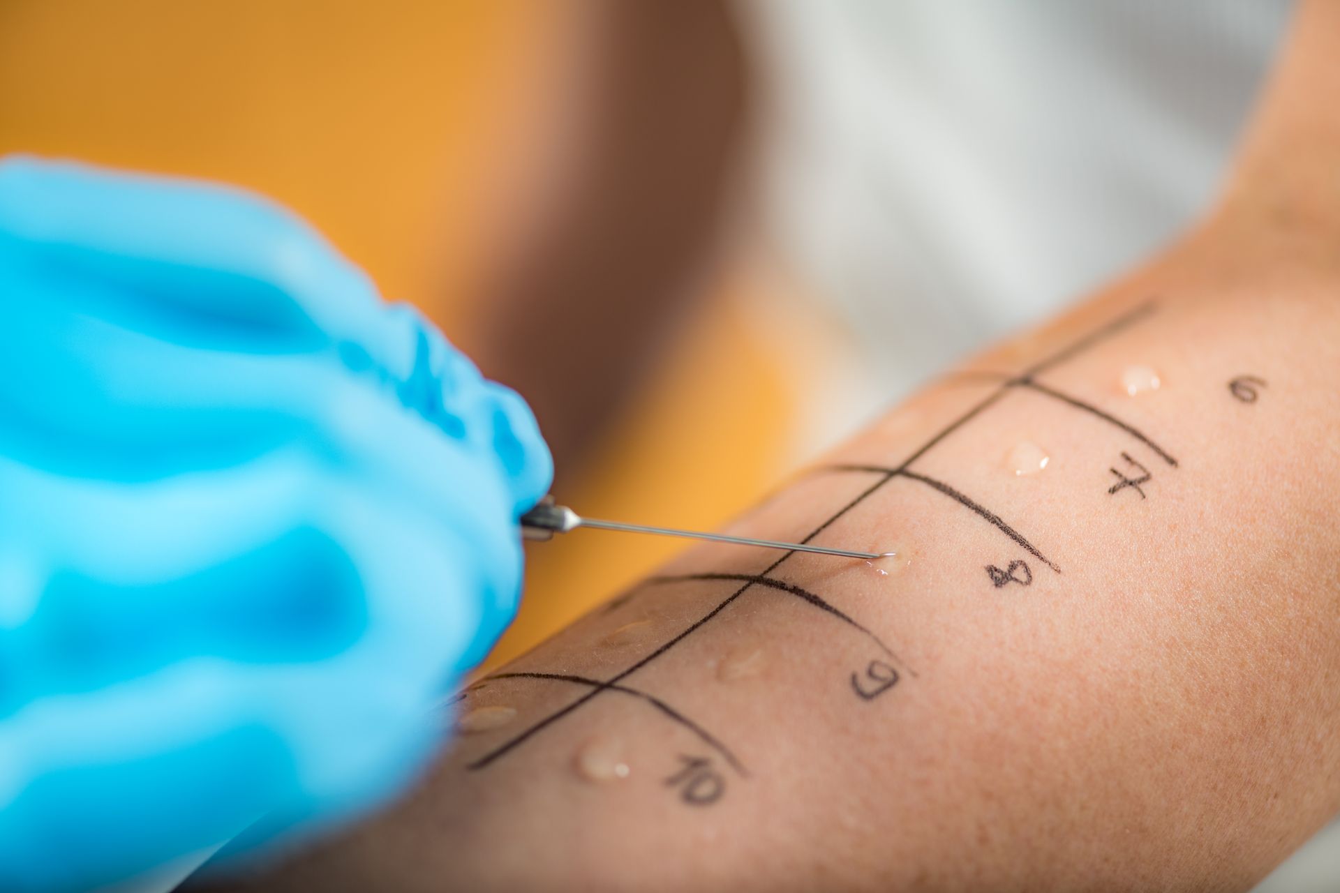 The Role of Allergy Testing