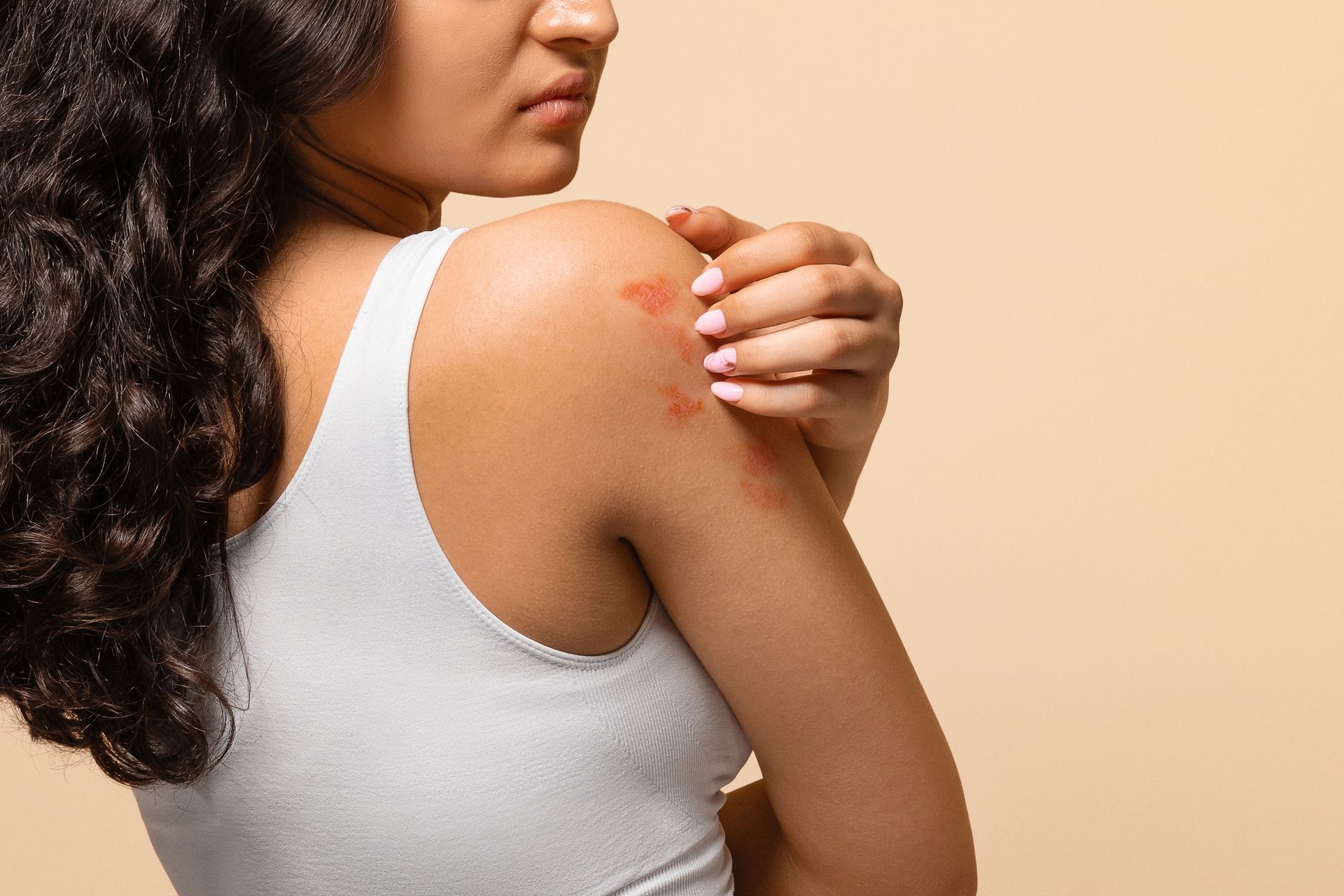 Effective Strategies for Managing Eczema During the Summer Months