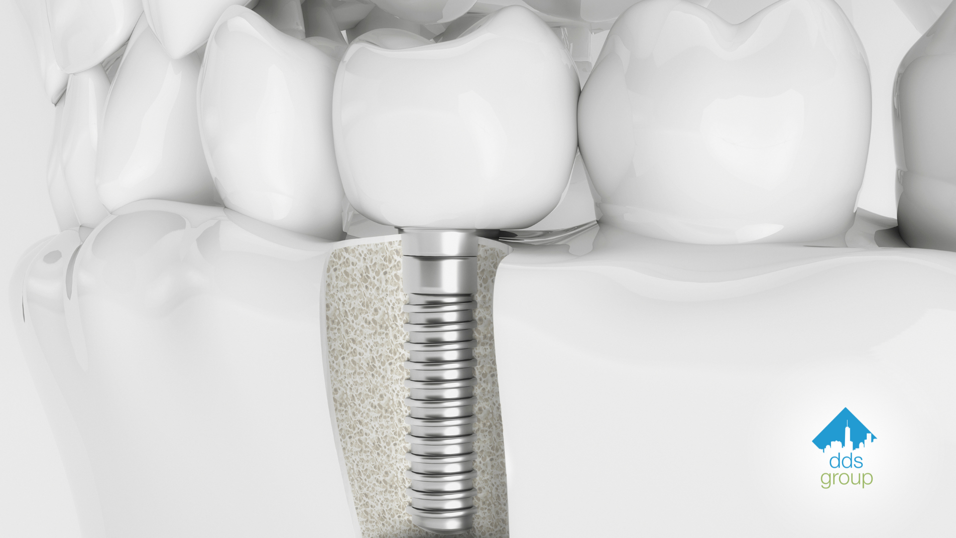 A close up of a dental implant in a person 's mouth.