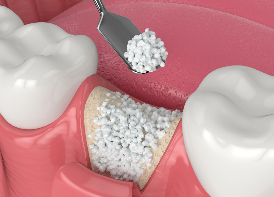 Close-up of a person's open mouth, showing teeth and inflamed gums, hands pulling the lip down.