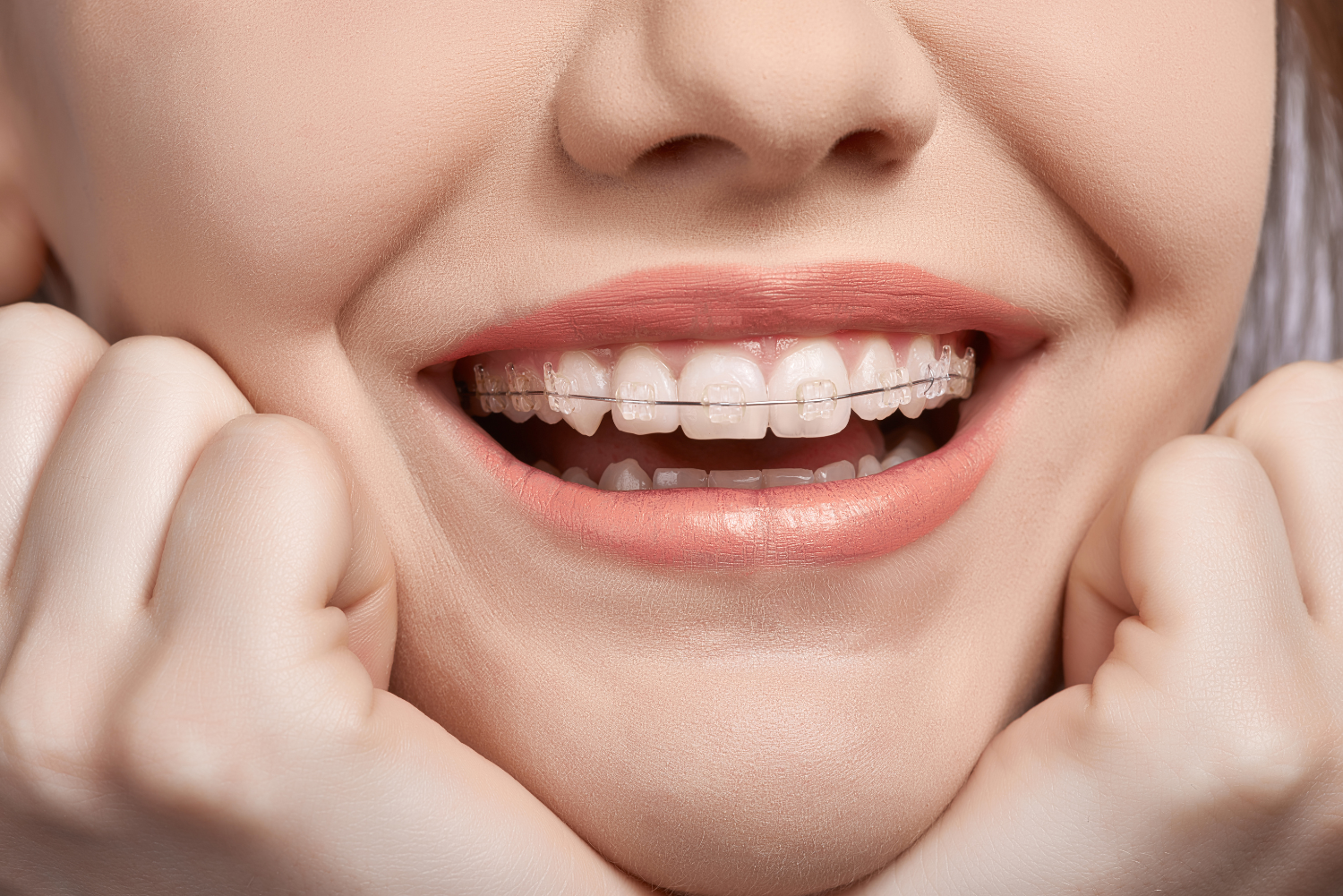 Close-up of a smiling mouth with clear braces. Pale pink lipstick, hands framing the face.