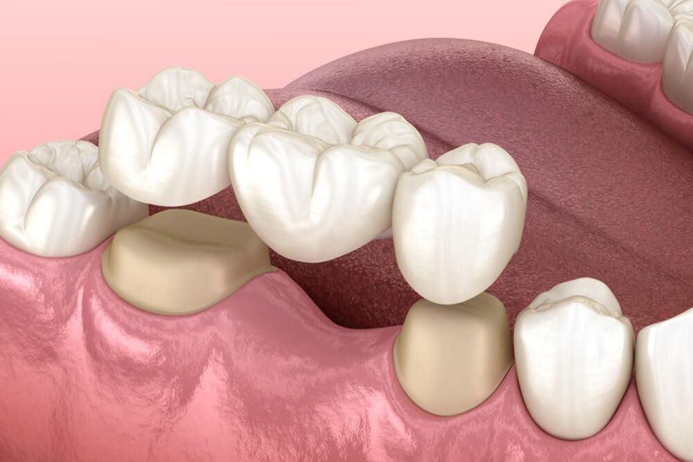 Dental bridge prosthetic in pink gums, replacing missing tooth with attached crowns.