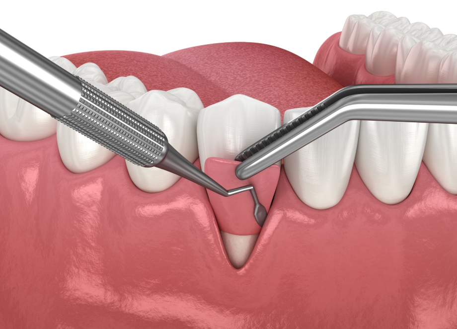 Woman's mouth with visibly inflamed, bleeding gums. Finger pulls lip, exposing teeth and gums against gray backdrop.