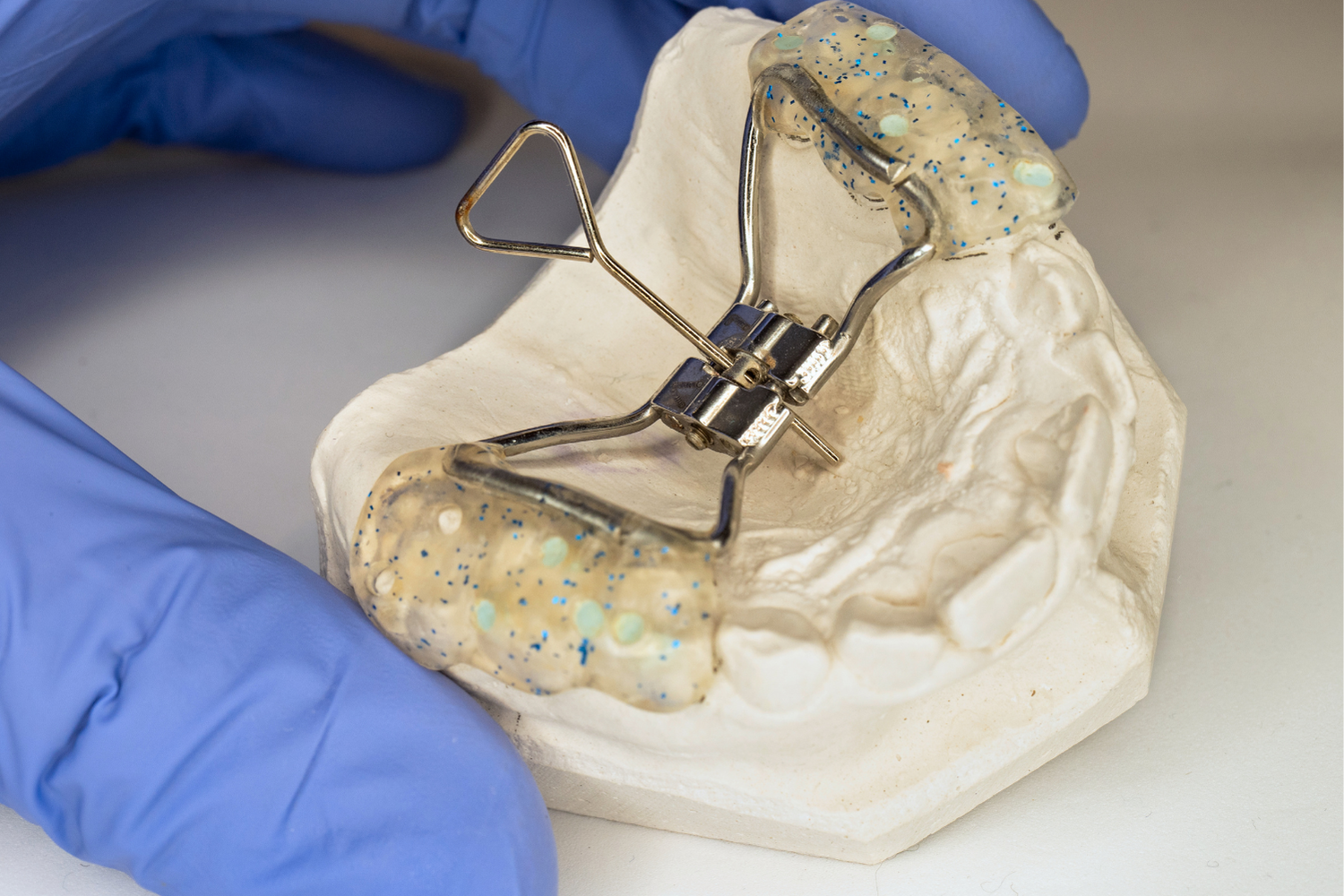 Person in blue gloves holding a dental appliance on a plaster cast, designed to widen the upper jaw.
