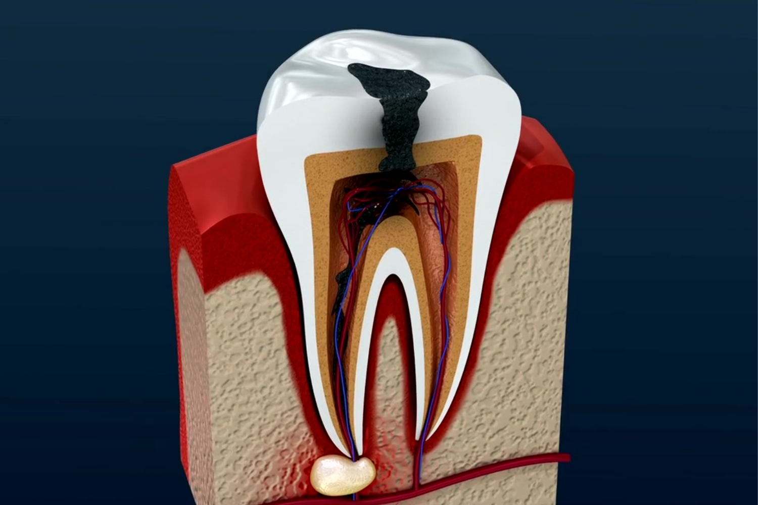 Cross-section of a tooth showing decay and infection. Black and brown areas within a white tooth, red gum.