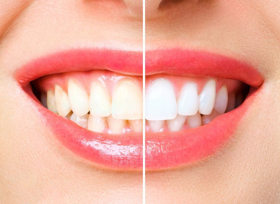 Side-by-side comparison of stained and whitened teeth, showing improved whiteness and brightness.