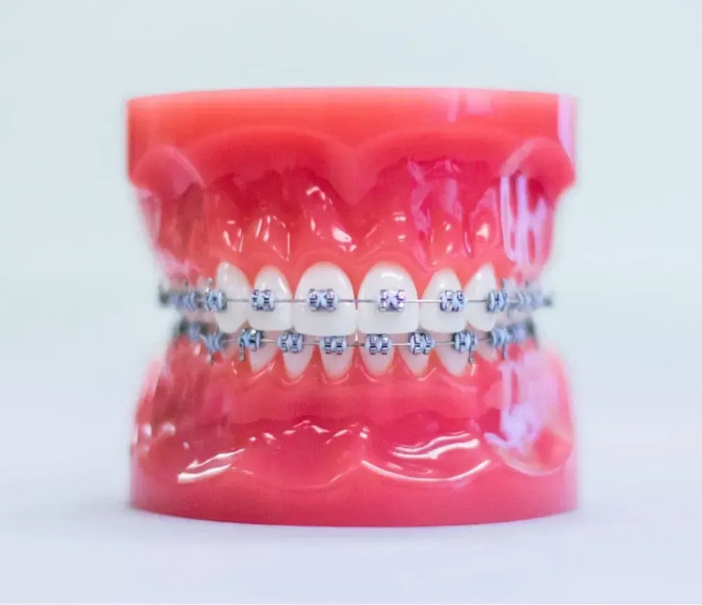 Dental model with metal braces on the upper and lower teeth; pink gums, white background.
