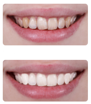 Teeth Before and After - Dental Services in Clifton Park, NY