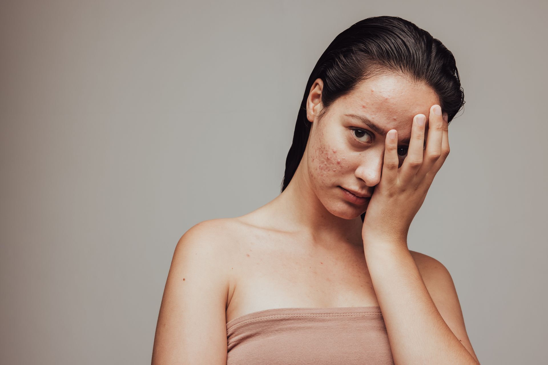 WOMAN WITH ADULT ACNE