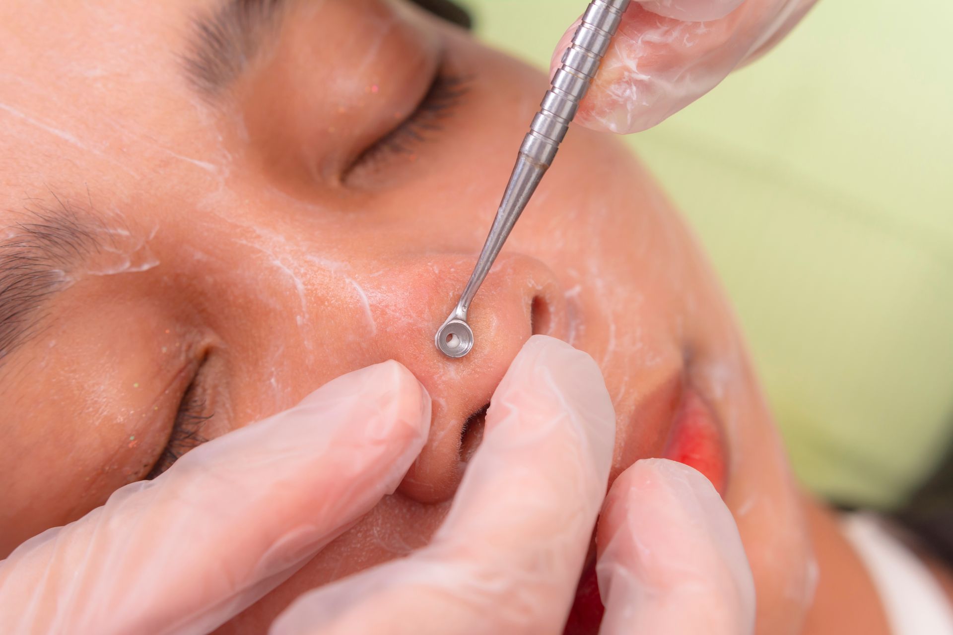 woman receiving extractions 