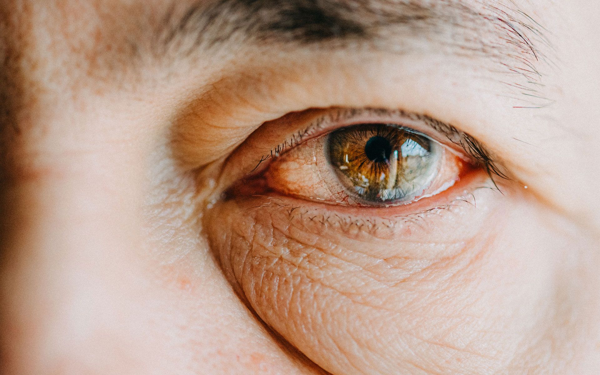 Close-up of an eye with reddish tint, indicating irritation.