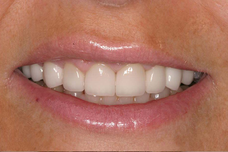 Dental Fillings After