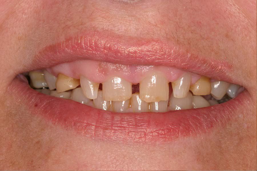 Dental Fillings Before