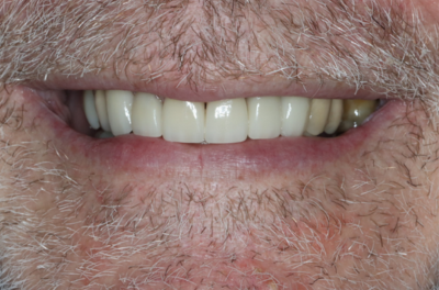 A close up of a man 's mouth with a beard and white teeth.