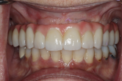 A close up of a person 's teeth with white teeth.