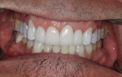 A close up of a man 's mouth with white teeth