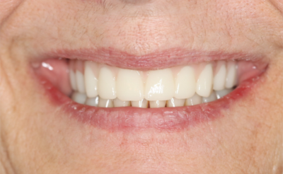 A close up of a woman 's smile with white teeth.