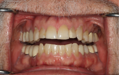 A close up of a man 's teeth with a beard.