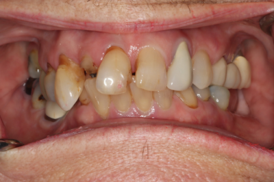 A close up of a man 's teeth with a lot of missing teeth.