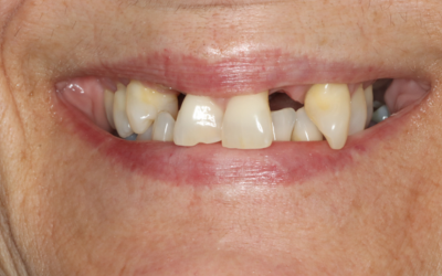 A close up of a woman 's mouth with missing teeth.