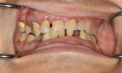 A close up of a man 's teeth with tweezers in his mouth.