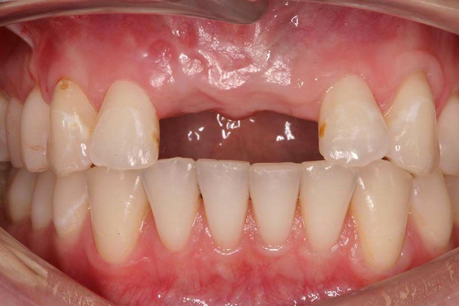 Dental Fillings Before