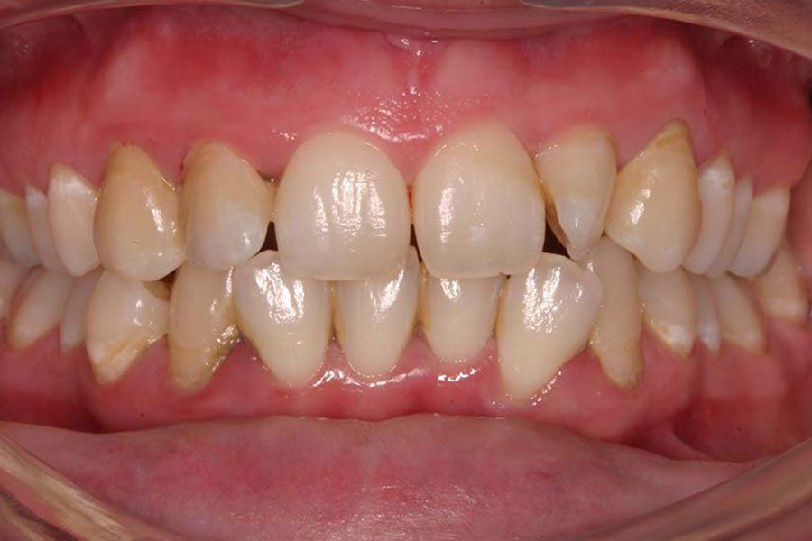 Teeth Whitening Before