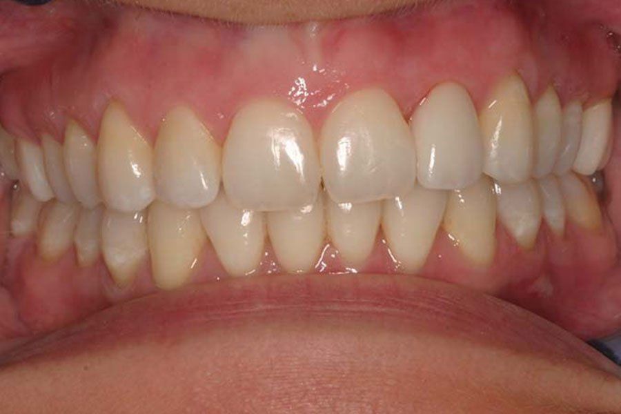 Teeth Whitening After