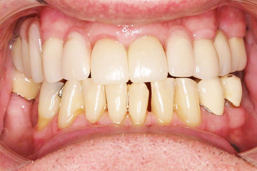 Dental Fillings After