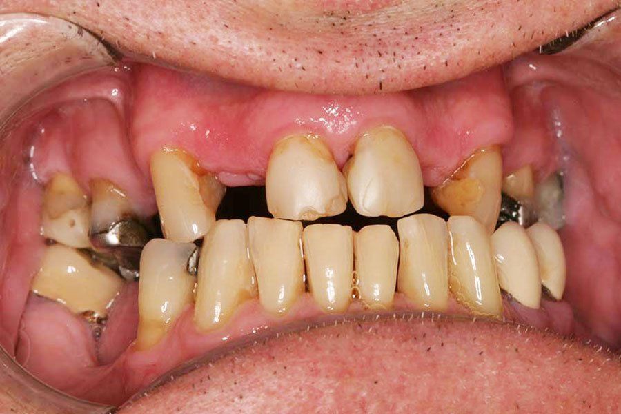 Dental Fillings Before