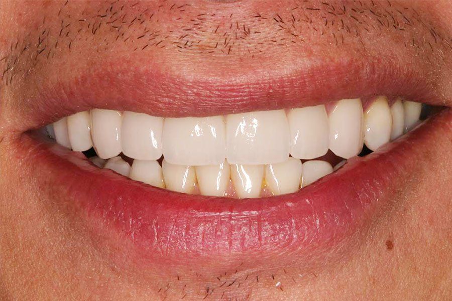 Dental Fillings After