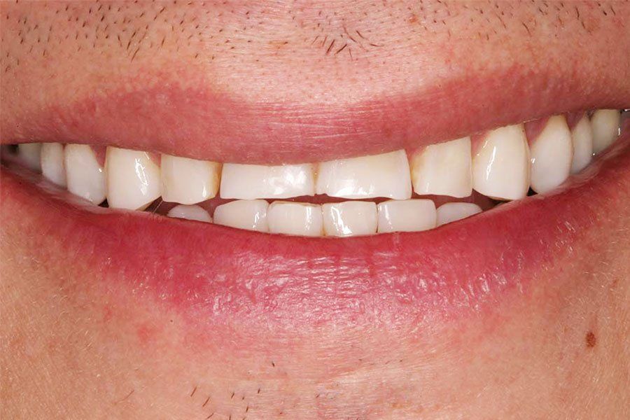 Dental Fillings Before