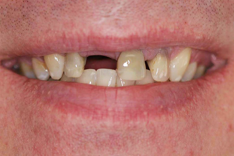 Porcelain Bridge Before